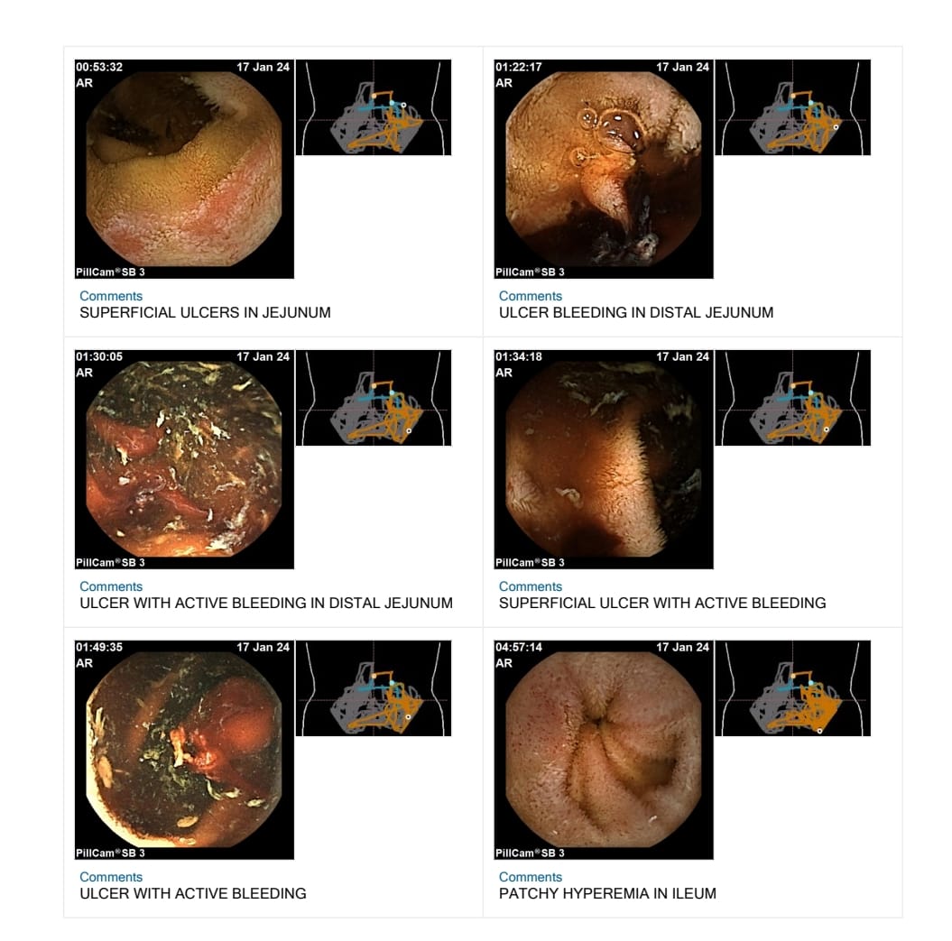 Endoscopy — Ulcers with Active Bleeding