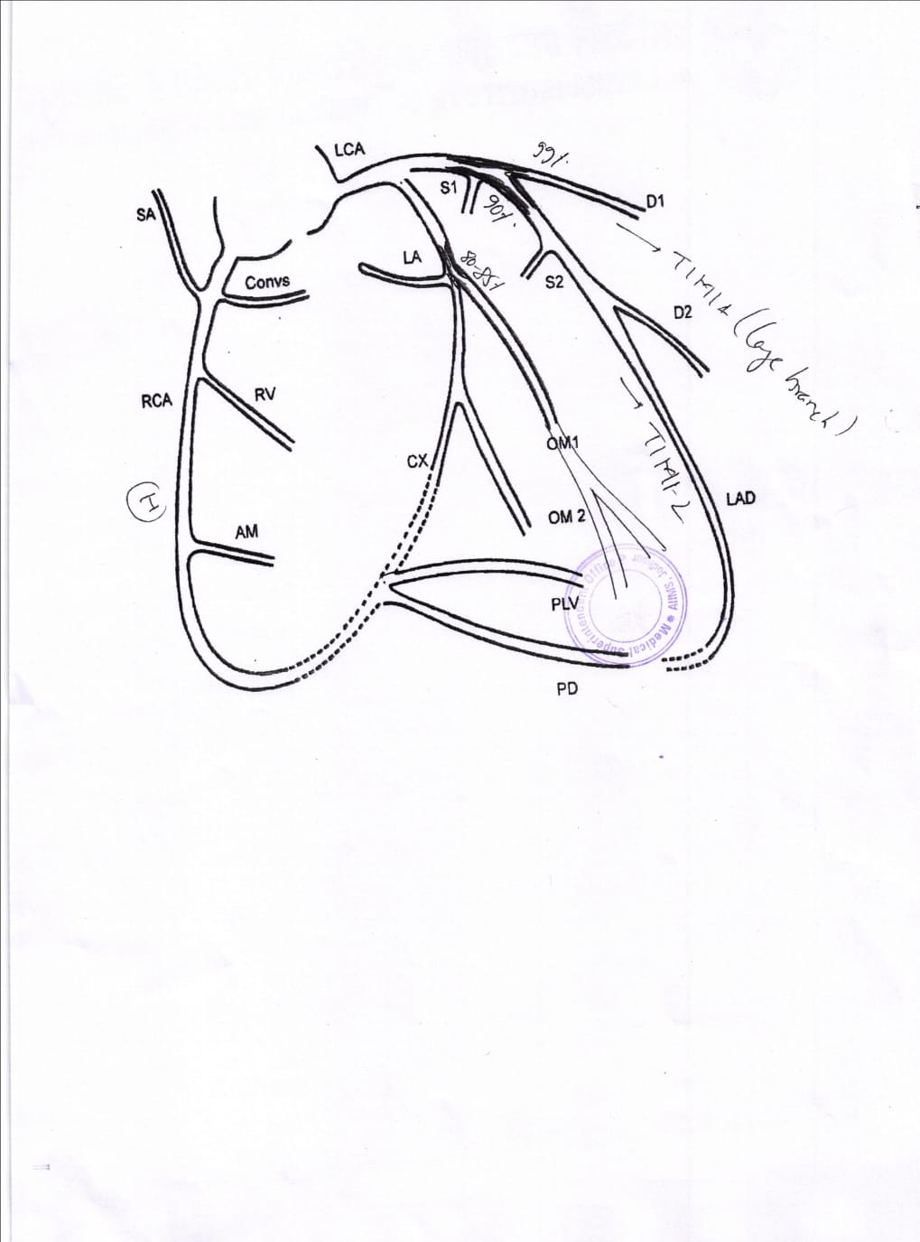 AIIMS Official Heart Blockage Diagram