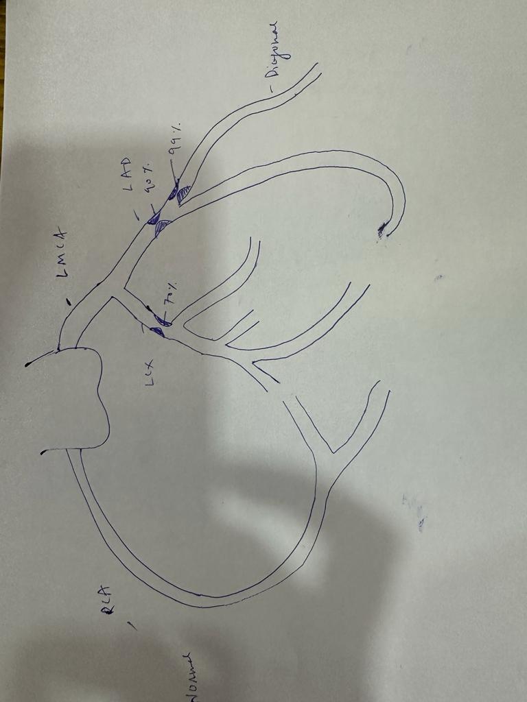 Heart Blockage Diagram — hand drawn